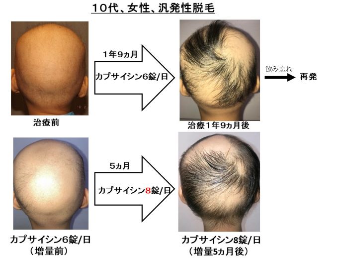 円形脱毛症　病院